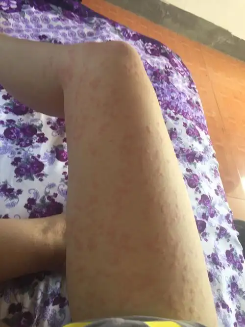 荨麻疹一个月了,吃盐酸西替利秦片,皮肤病血毒丸,氯雷他定片……等