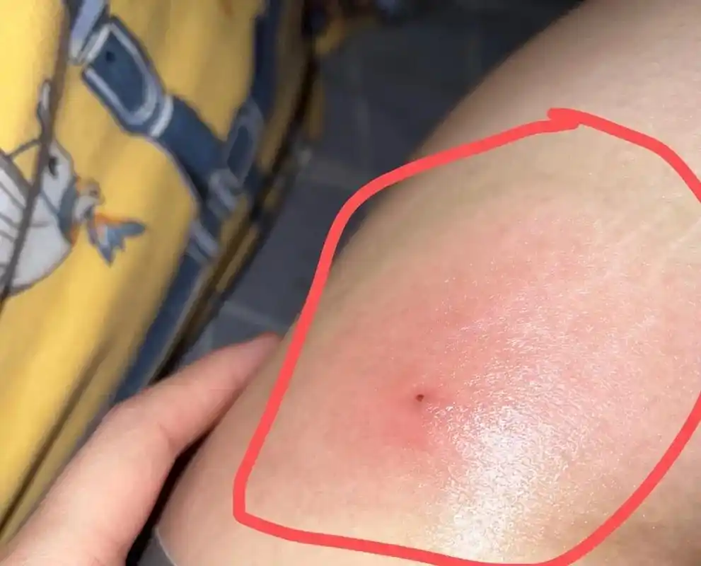 第一次长这么大的火疖子,今年可真的太难了,受了