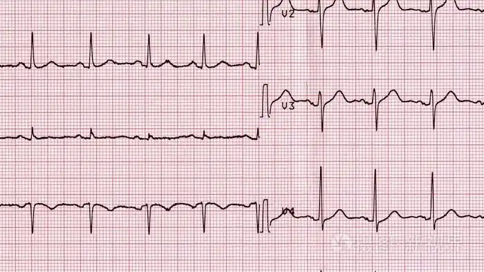 心电图学的心脏的跳动