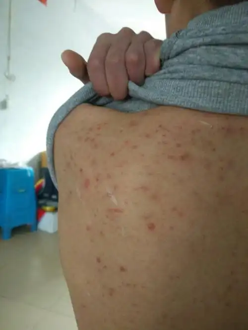 我才14岁,怎么背上长了这么多痘痘?