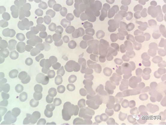 面对一份「高冷」的红细胞凝集标本,你会如何处理?