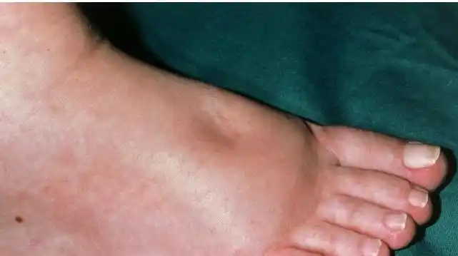 肾病常见的症状表现和体征变化二水肿高血压