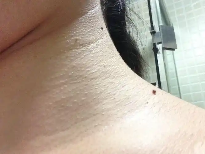 问:我的脖子上长了很多小肉疙瘩,长的可以揪起来,我试过自己将它揪掉