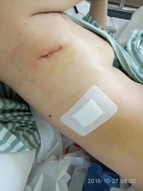 这是拔胸管及arrow 管后的照片