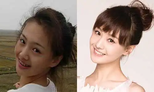 5位女星「整牙前vs整牙后」的超惊人对比:林心如整后笑容可人,唐嫣真