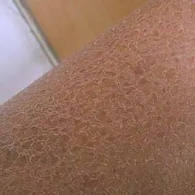 腿部皮肤有菱形是鱼鳞病吗