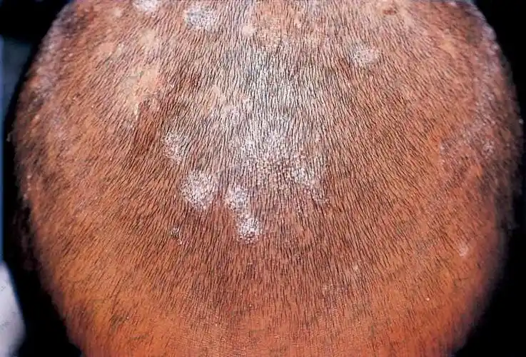 头癣(黄,白,黑)诊疗参考:真菌感染头皮毛发所致 - 皮肤病学 - 天山