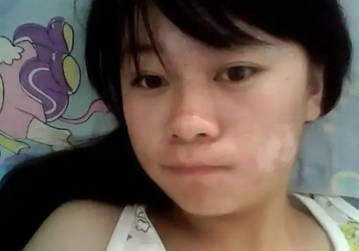 白癜风是一种随着病情发展而不断变化的皮肤白斑病,可以根据白癜风的