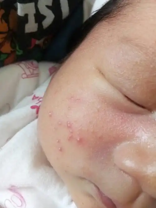 宝宝湿疹头上怎么办(婴儿湿疹长头皮上怎么办)