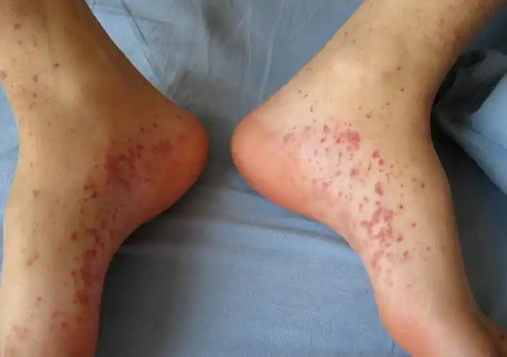 认识形形色色的糖尿病皮肤病变