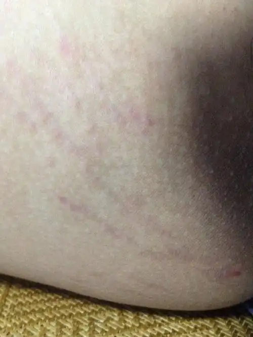 大腿内侧发黑已经好多年了,以前不知是病,最近周围有红丝出现.