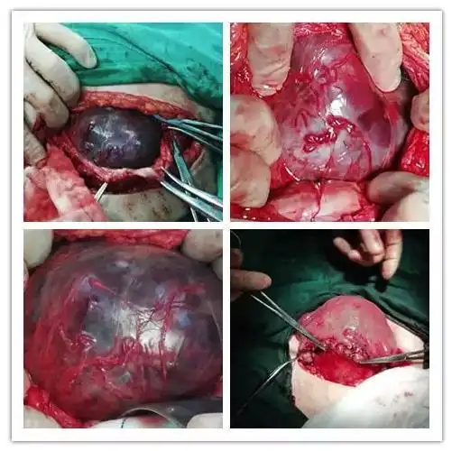 增生怒张的血管,血窦,小心分离粘连后才能看见正常的解剖结构,胎盘已