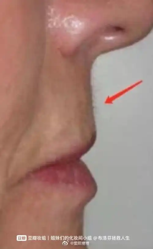 不是只有凸嘴才整牙正畸深覆合瘪嘴也需要整牙正畸