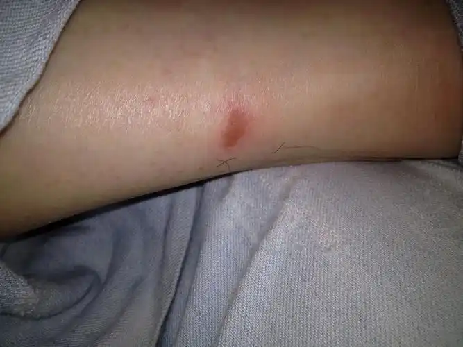 昨晚好像被虫子咬了,留下个伤口,是什么情况