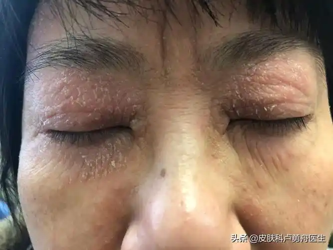 虽然科普了很多次,依然有很多人在咨询眼睛周围的神经性皮炎,这里再和