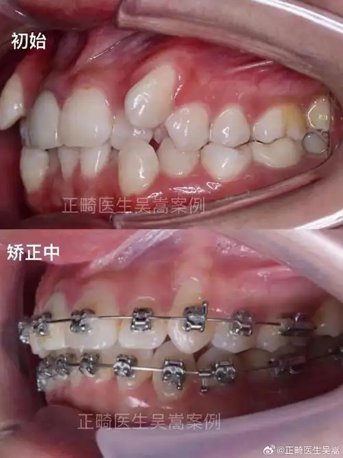 牙齿矫正##正畸##南京牙齿矫正