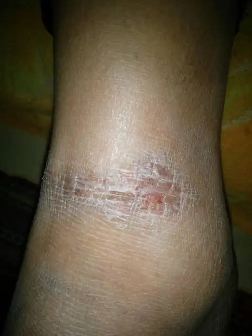 请问,脚脖子上长的像癣的一块硬皮,三年了,痒,挠挠会疼,请问大夫这是