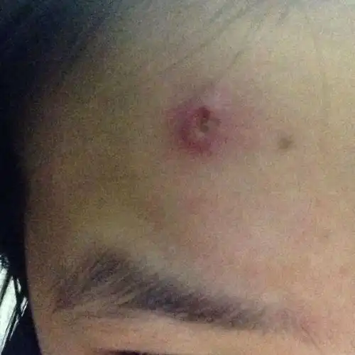 想请问这是什麼? 本来好像是痘痘 然后突然肿起来 有硬块含脓 好疼