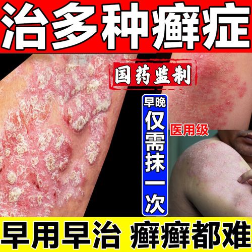 3盒装【克霉唑特】*【疗程装】顽癣敌效药