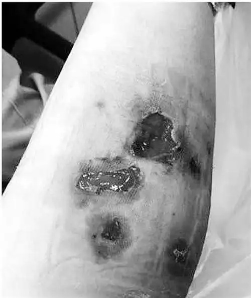 28岁姑娘注射"瘦腿针",腿部溃烂差点截肢