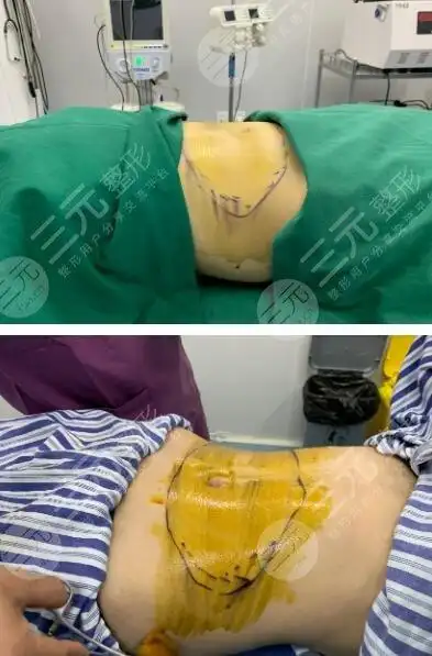 腹部吸脂的费用,你具体了解多少呢?腰腹吸脂注意事项