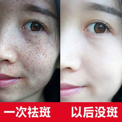 丹雪尼兰美白祛斑霜祛色斑黄褐斑雀斑中老年老年斑晒斑面部护理套装