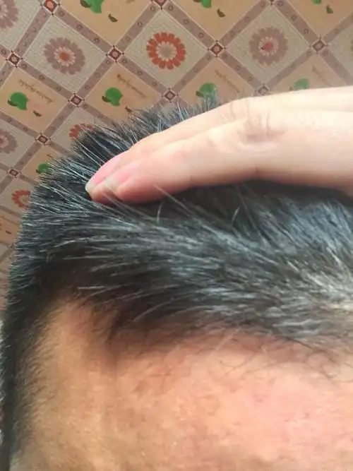 发根一开始长就这样,头发出来刘海卷,怎么办