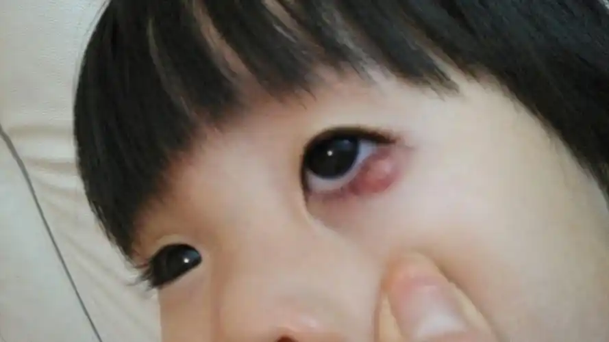 10月初,左眼下眼睑少许发红,然后慢慢鼓出红包,不疼也不痒_百度宝宝