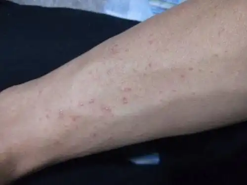 就小手臂有好像过敏一样 但是不疼不痒 身上一点没有求专家帮看看