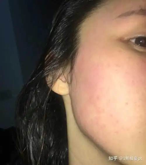 皮肤敏感泛红应该怎么修复? - 知乎