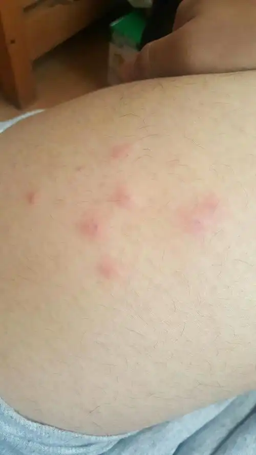 突然特别痒一抓就起了一些小疙瘩不知道是什么原因