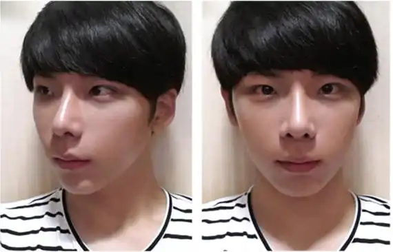 韩国男生整容案例恢复效果惊人