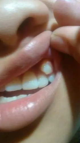 牙齿也长得很密很齐,最近突然发现她门牙牙龈那边又往外长了一颗牙齿