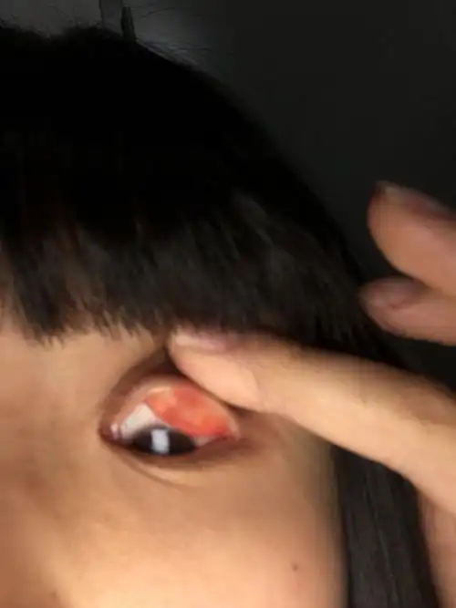 左眼皮里长了一个疙瘩,不痛不痒,长了三个月了,因为不痛不痒也没去看