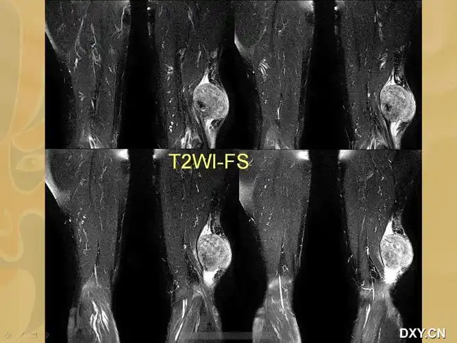 【读片】老年男性,大腿肿块,一周后公布病理. [病例帖]