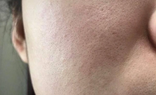 毛孔粗大救星找到了不是收敛水3个方法毛孔细到看不见