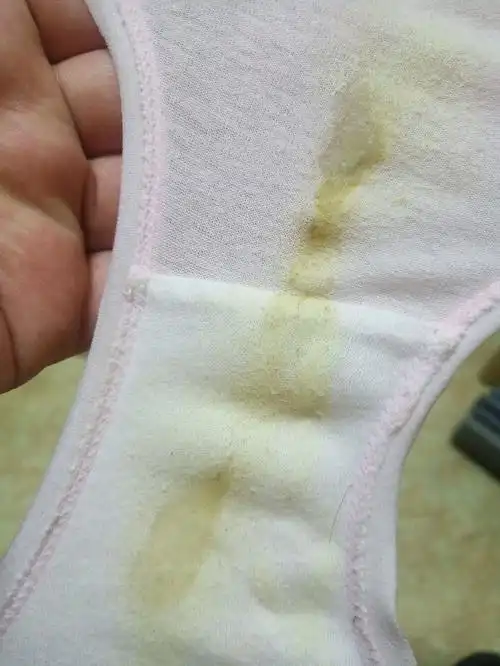 白带发黄怎么办