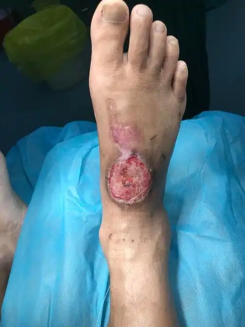右足背烫伤后皮肤坏死缺损-医联