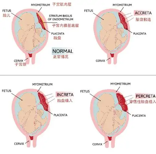 胎盘植入,是指胎盘组织不同程度地侵入到子宫肌肉层的一种疾病.