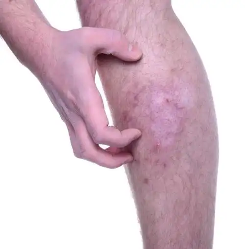 抓挠皮肤瘙痒,手抓痒感染皮肤.