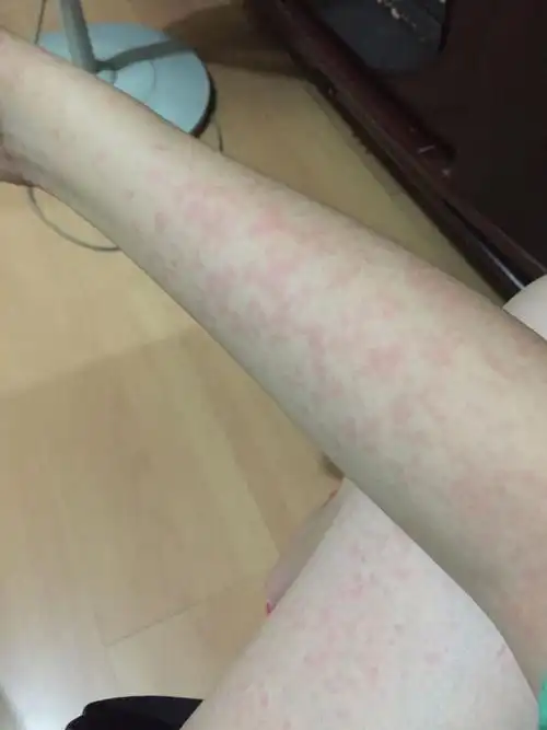 图是洗了澡后拍的 会痒 洗了不痒些 是皮肤过敏什么的症状吗 有半年了