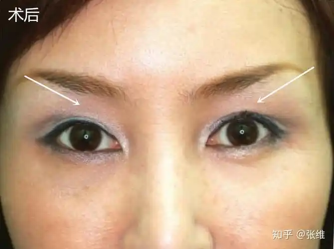 眼窝凹陷的治疗方法