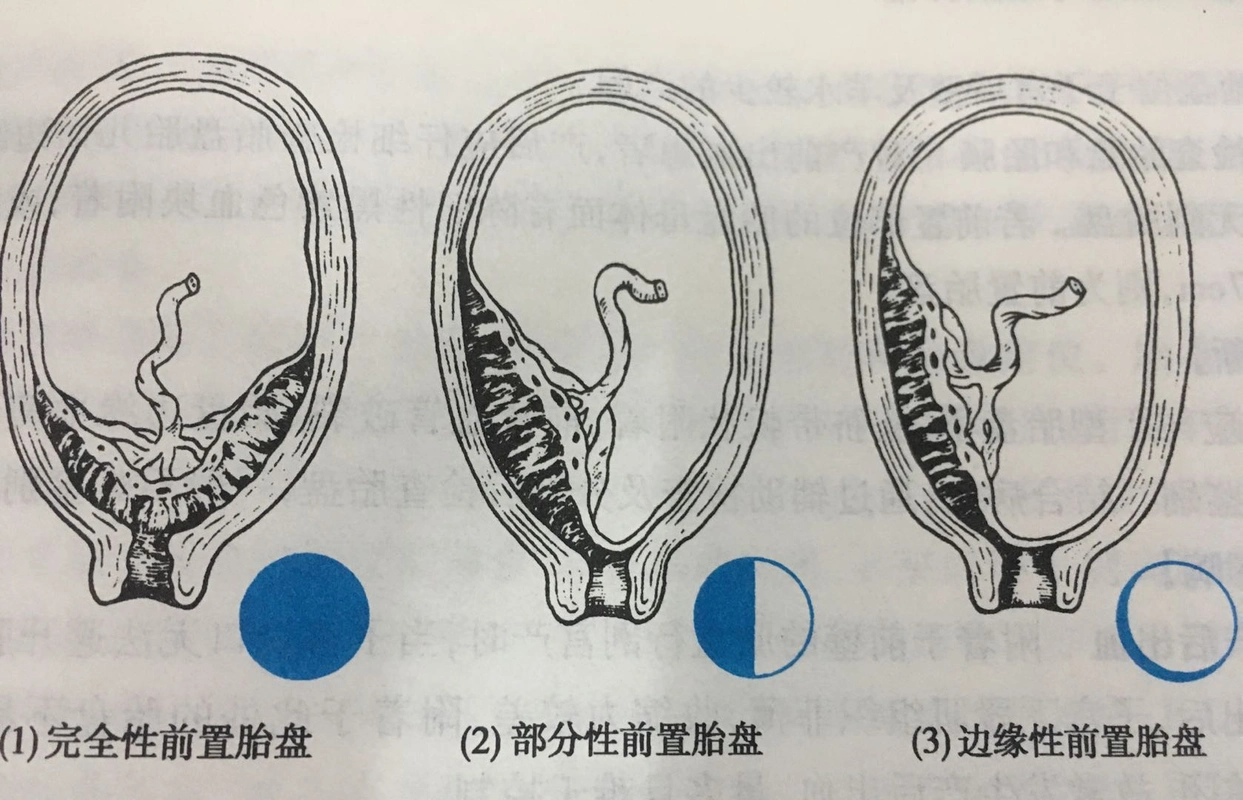 胎盘位置低出血,需要引产吗?