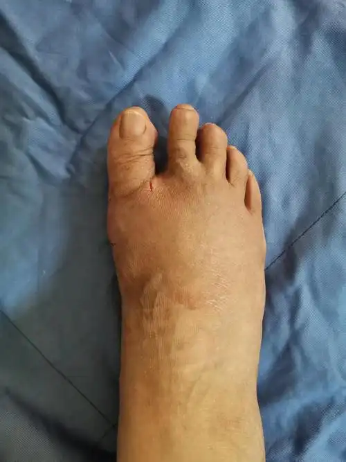 微创手术治疗拇外翻,医保报销,费用低,术后即可下地,三天出院