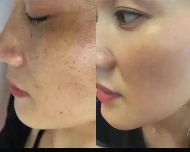 淡斑祛斑最有效的方法,你知道多少,一起来看看吧_肌肤_成分_黑色素