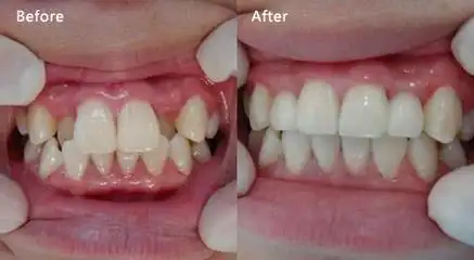 长了虎牙轻易不要拔除