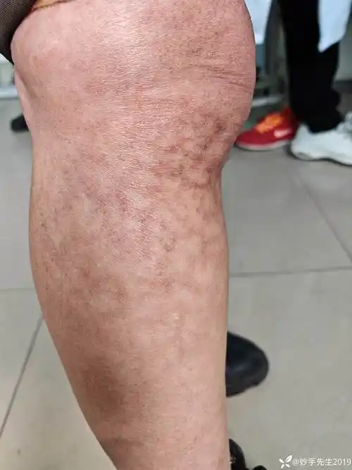 腓骨近段皮肤颜色呈花纹状引发的思考
