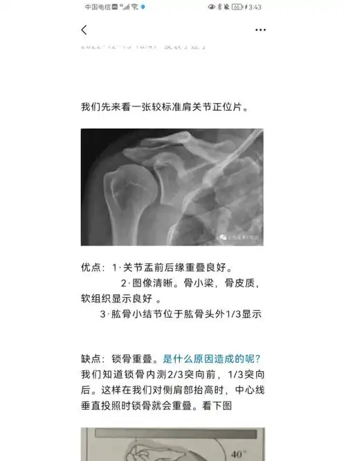 如何拍出标准的肩关节正位