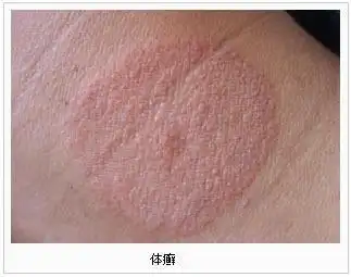 艾滋病体癣图片,出现体癣也有招