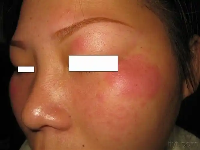 看图识病---------系统性红斑狼疮